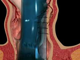 phương pháp cắt khâu từng búi trĩ